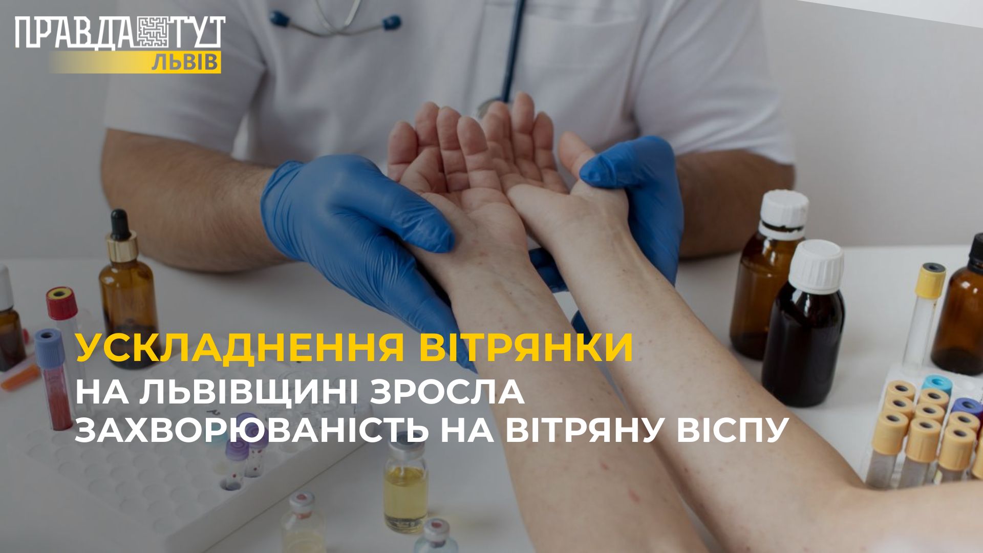 Ускладнення вітрянки: захворюваність в області збільшилась