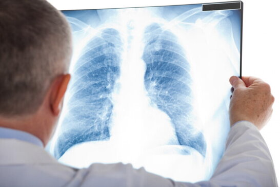В Україні вперше почали використовувати ШІ для діагностики туберкульозу