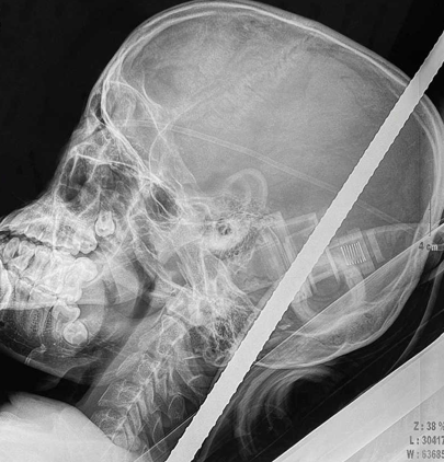 Хірурги успішно дістали з черепа 18-річного в’єтнамця арматуру, що проштрикнула череп