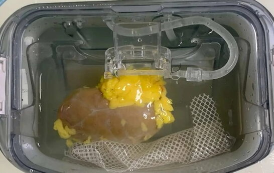 Науковці вперше створили універсальну нирку, сумісну з будь-якою групою крові