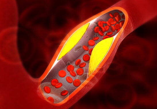 Чому важливо контролювати рівень холестерину