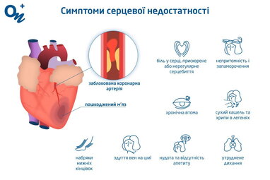Серцева недостатність: причини, чим небезпечна, симптоми, стадії і типи
