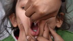 На Закарпатті у п'ятьох дітей виявили поліомієліт