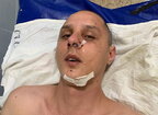"Перелом черепа і погано бачу": у Києві напали на композитора гурту "Kazka"